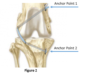 TIghtrope surgery for surgery repair of a torn CCL in dogs